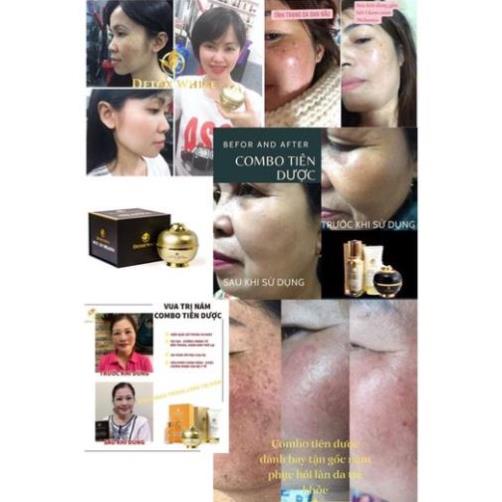 Cao Hỗ Trợ Da Nám, Tàn Nhang Detox White White Skin Melasma 35gr