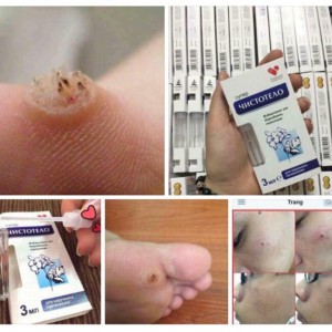 Kem tẩy nốt ruồi, sẹo lồi, mụn cóc hiệu quả | BigBuy360 - bigbuy360.vn