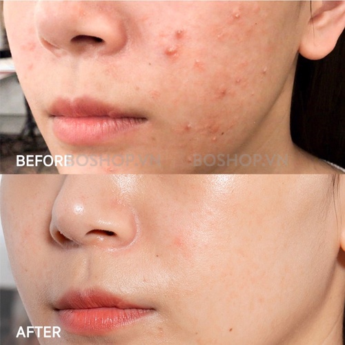 Gel Tretinoin Menarini USP Giảm Mụn, Mờ Thâm Chống Lão Hoá 20g