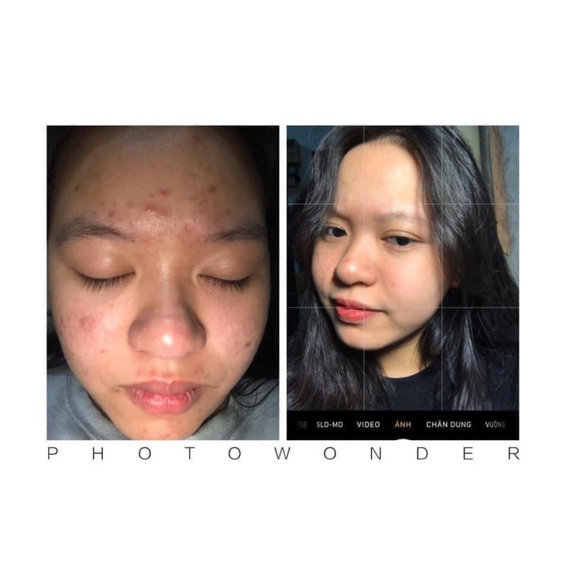 Kem Face MỤN cao cấp DIVA LYN Hàn Quốc | BigBuy360 - bigbuy360.vn