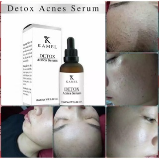 KAMEL DETOX ACNES SERUM