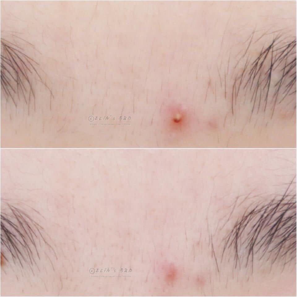 Toner Trị Mụn + Sữa rửa mặt Ngăn CARYOPHY Ngừa Mụn Đẹp Da Chính Hãng Hàn Quốc | BigBuy360 - bigbuy360.vn