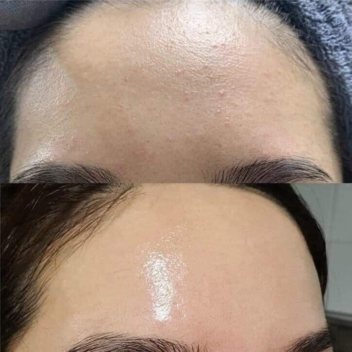 Sữa Rửa Mặt Farmona Dermacos Anti Acne Deep Cleansing Gel - 150ml