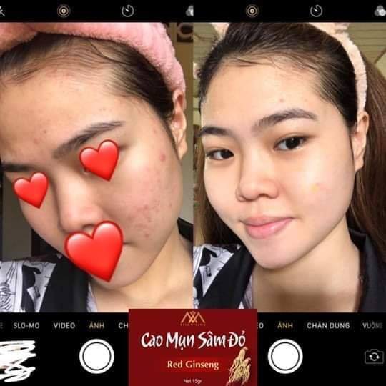 Cao MỤn Sâm Đỏ Tri Mụn Và Dưỡng Da | BigBuy360 - bigbuy360.vn