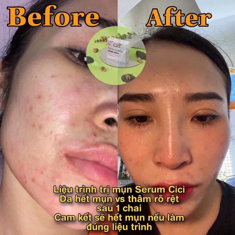 HỘP SERUM MỤN🌱