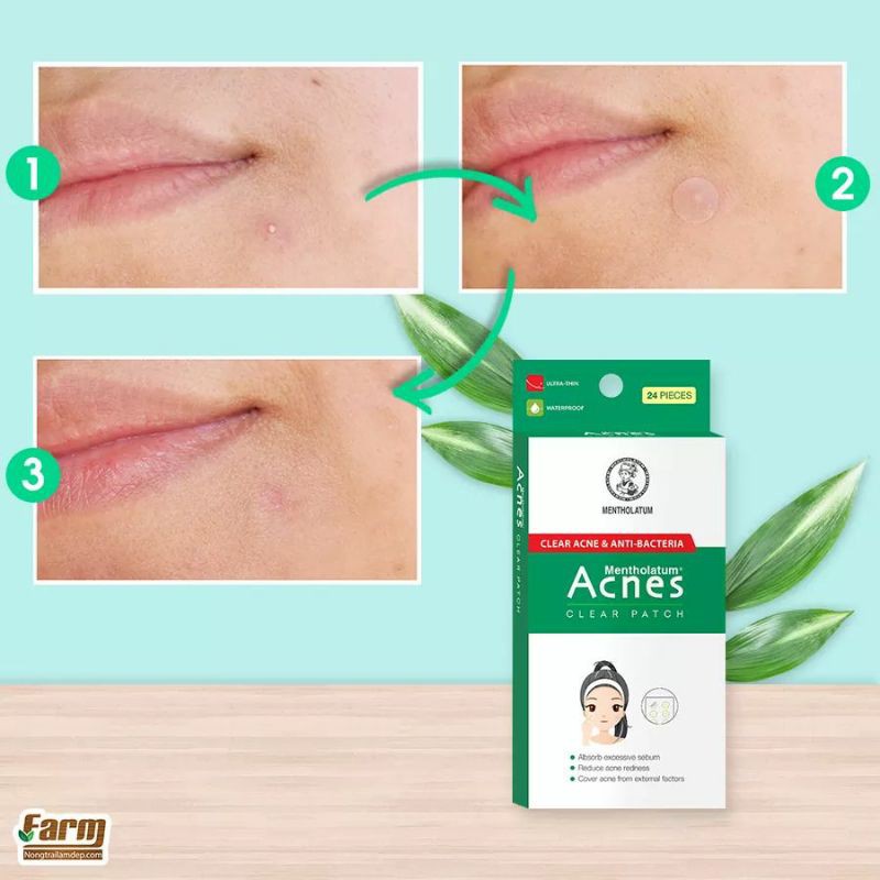 miếng dán mụn acnes giúp sạch da