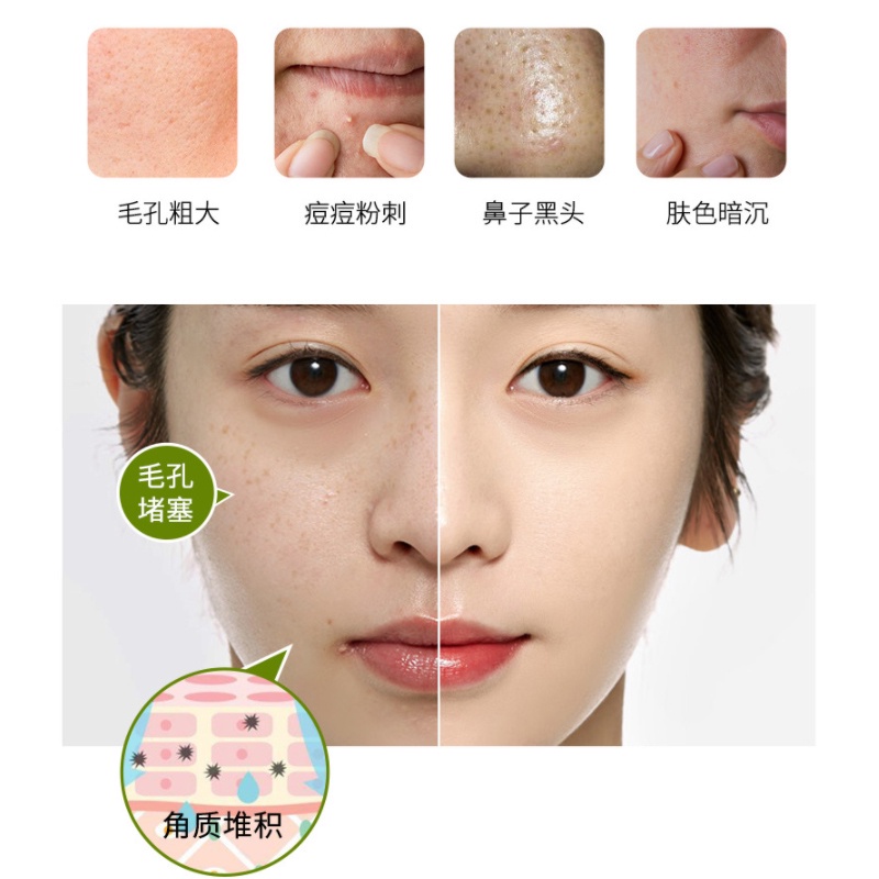 [Hàng mới về] Gel tẩy tế bào chết ORANOT làm sạch sâu loại bỏ mụn đầu đen hiệu quả