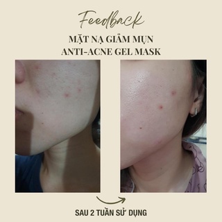 COMBO mặt nạ thải độc da - mặt nạ giảm mụn handmade