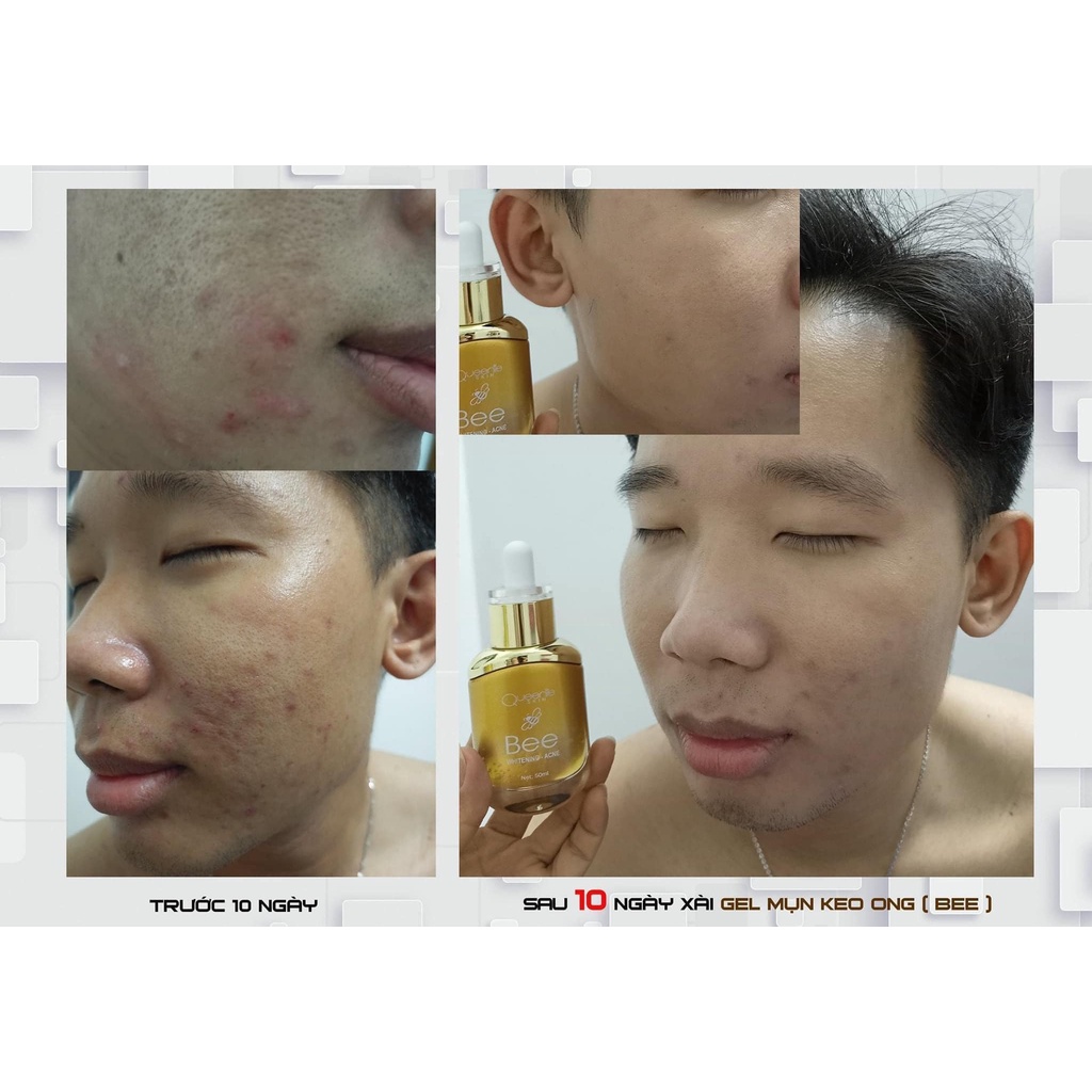 [FreeShip + Tặng Quà] Gel Mụn Keo Ong Queenie Skin Date Mới Nhất - Gel Mụn Queenie Skin Date 2023