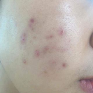 Kem mụn Spa Hàn