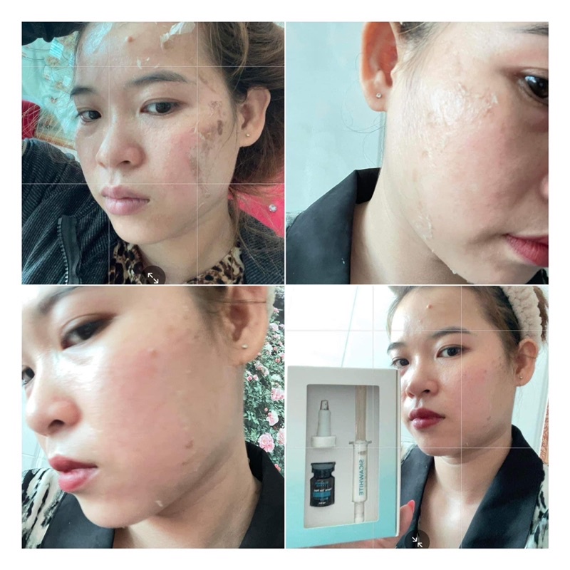 PEEL DA VI TẢO NANO GIÚP LOẠI BỎ LÀN DA KHÔ XẠM TRỞ NÊN MỀM MẠI