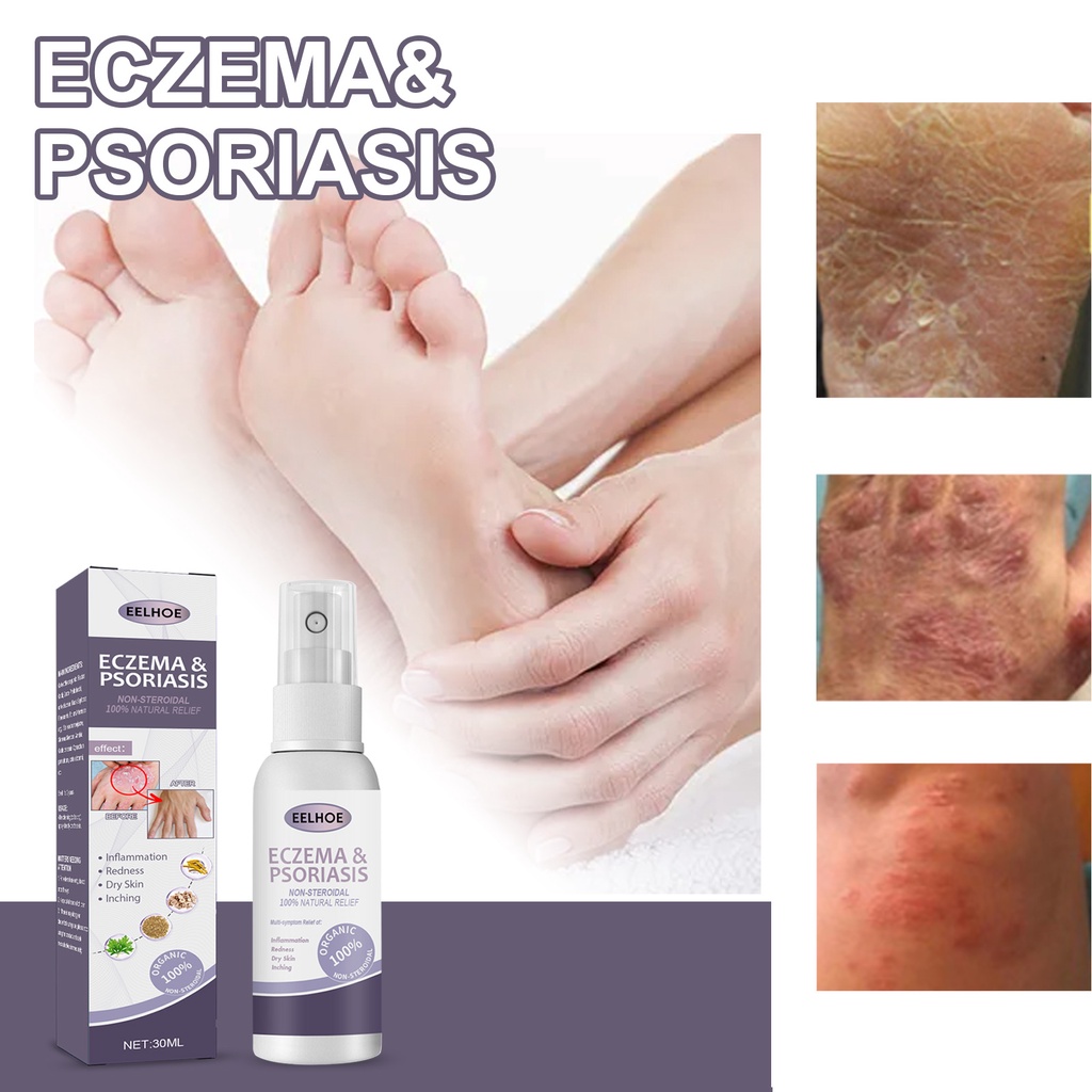 EELHOE Tinea Pedis   Mỡ Trị Chàm Da Đầu Bệnh Vẩy Nến Bàn Tay Mùi Hôi Chân Nấm Nhiều Màu Ức Chế Nấm Chống Ngứa Sản   Chăm Sóc Cơ Thể