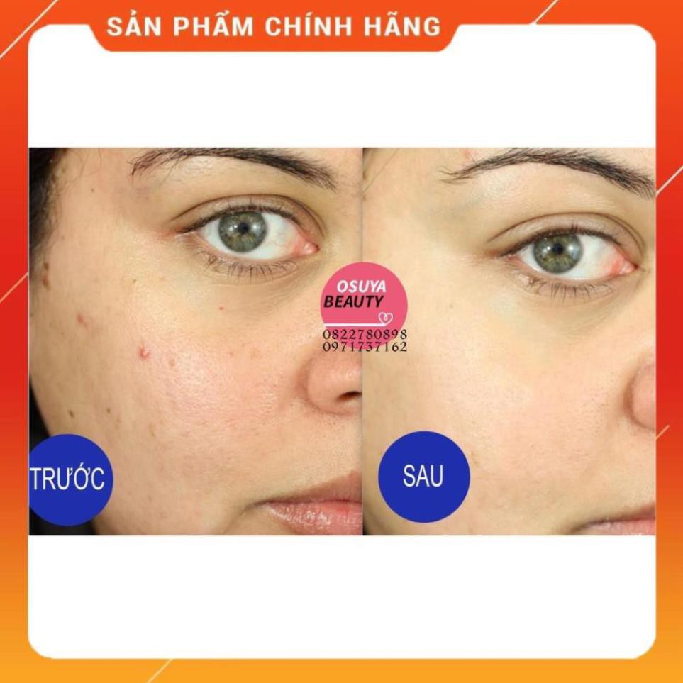 [Hàng Xịn] Gel Trị Mụn Trứng Cá Và Mụn Đầu Đen Cao Cấp Fixderma Luxury FCL Alpha-Beta Acne Gel 30ml