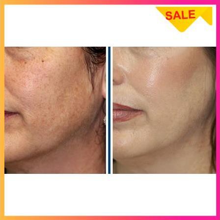 [SIÊU KHYẾN MÃI]Serum Skin 7 Days giảm mụn thâm - chống lão hóa hiệu quả sau 7 ngày | BigBuy360 - bigbuy360.vn