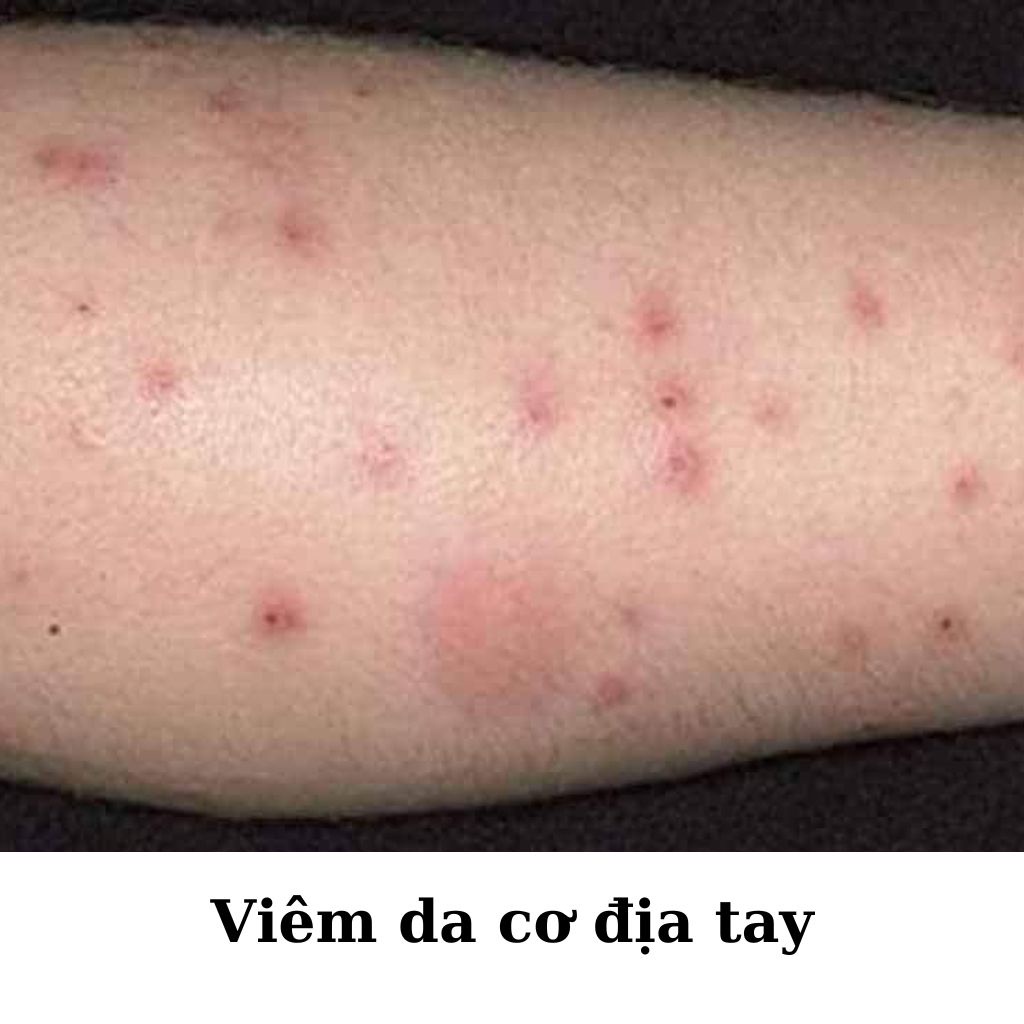[ ZUDAIFU ] Kem bôi Viêm da cơ địa, Hắc lào, Nấm ngứa đầu, Chàm, Tổ đỉa, Ghẻ nước, Lang ben, Á sừng, Vảy nến, tuýp 15Gr