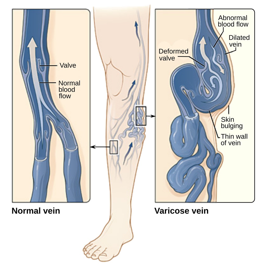 Tất/vớ y khoa điều trị suy giãn tĩnh mạch