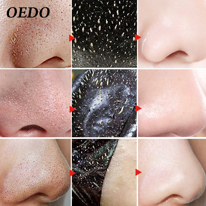 Set 2 sạch mụn đầu đen mũi OEDO