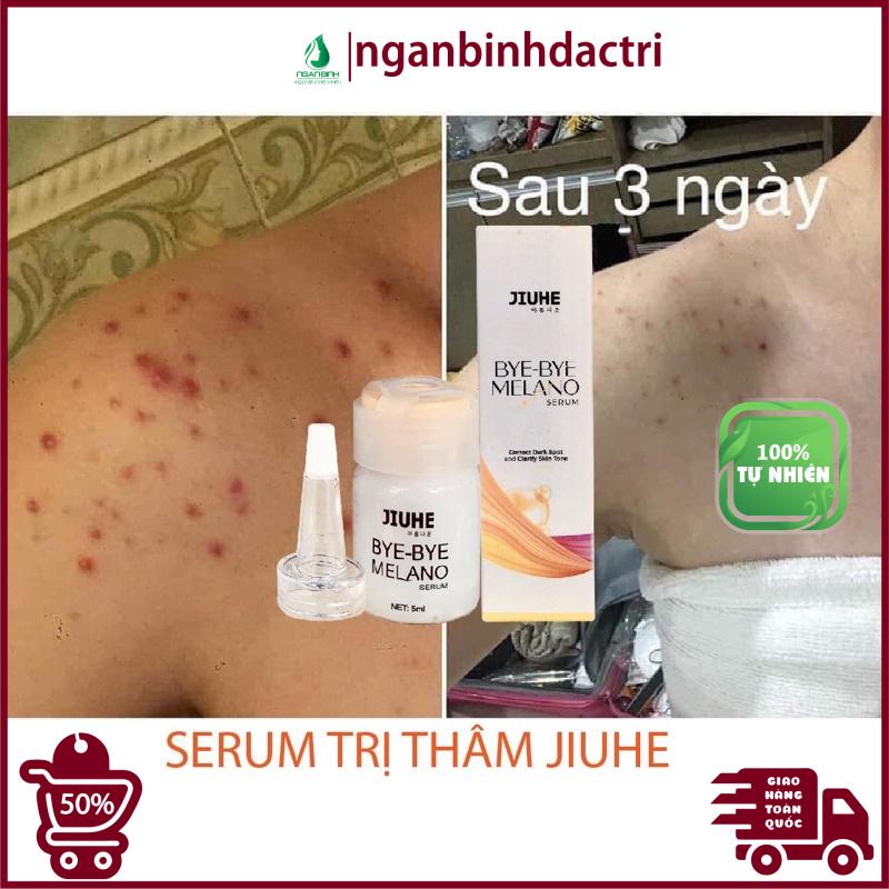 Serum tri thâm hàn quốc JIUHE Q-PEARL giảm thâm do mụn khửu tay chân, thâm sẹo, thâm nách hiệu quả