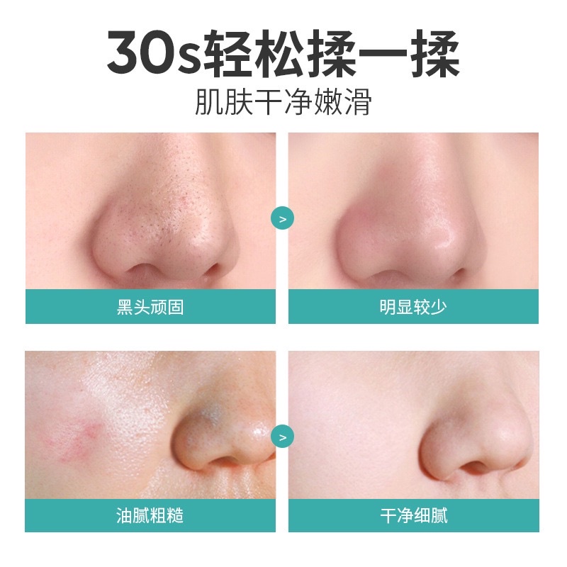Tẩy da chết mặt Quarxery sạch sâu lcl, đánh bay mụn cám | BigBuy360 - bigbuy360.vn