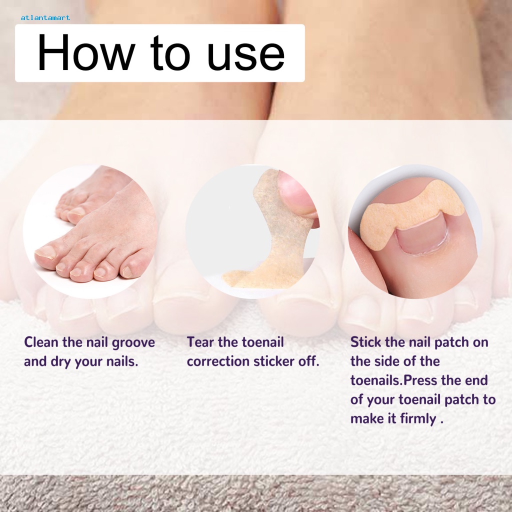 Atl| Miếng Dán Chỉnh Hình Móng Chân Mọc Ngược Tiện Dụng