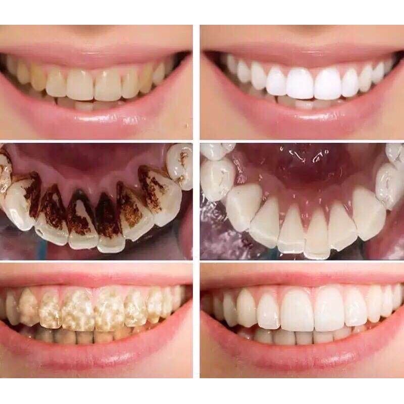 COMBO 2 HỘP Than Hoạt Tính trắng răng chống hôi miệng Whitening Teeth