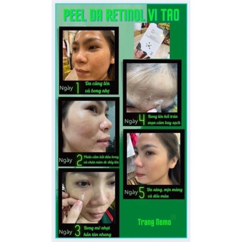 Peel da Trang Nemo Retinol vi tảo - tái tạo da căng bóng, hết mụn nám khuyết điểm