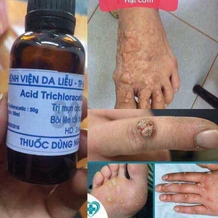 Loại Bỏ Mụn Cơm - Mụn Cóc - Mắt Cá Chân Viện Da Liễu - Acid Trivhloracetic 80% | BigBuy360 - bigbuy360.vn