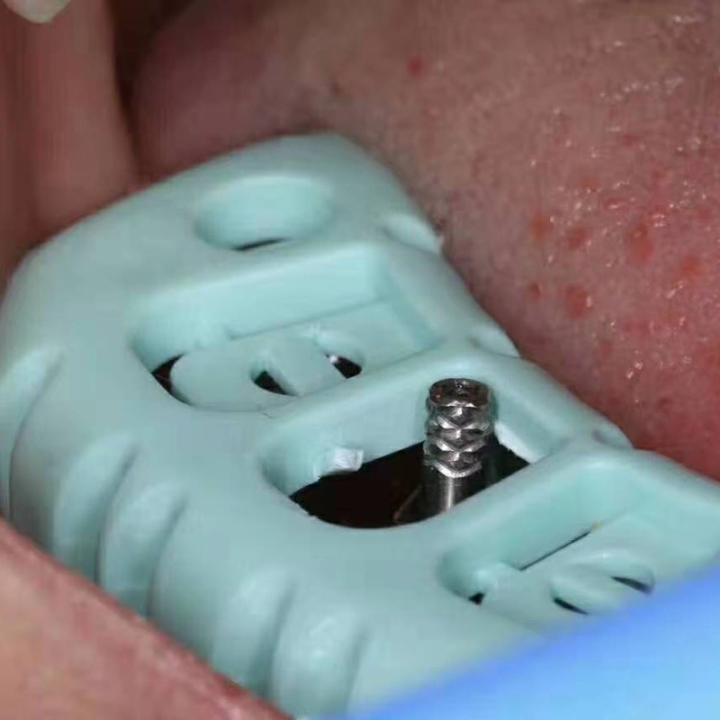 THÌA LẤY DẤU IMPLANT - THÌA LẤY DẪU RĂNG IMPLANT NHA KHOA