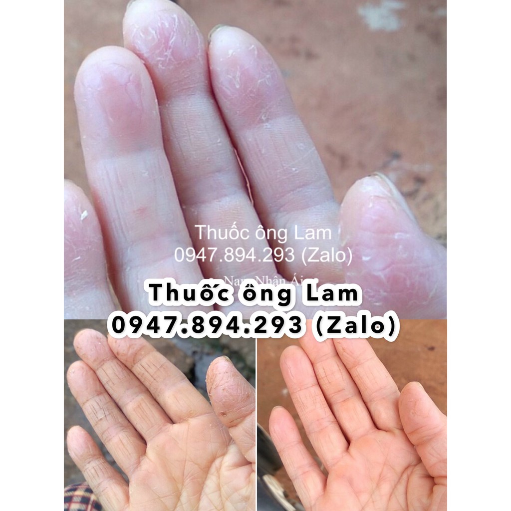 Tổ đỉa, chàm, chàm sữa, mẩn ngứa, cơ địa Ông Lam | BigBuy360 - bigbuy360.vn