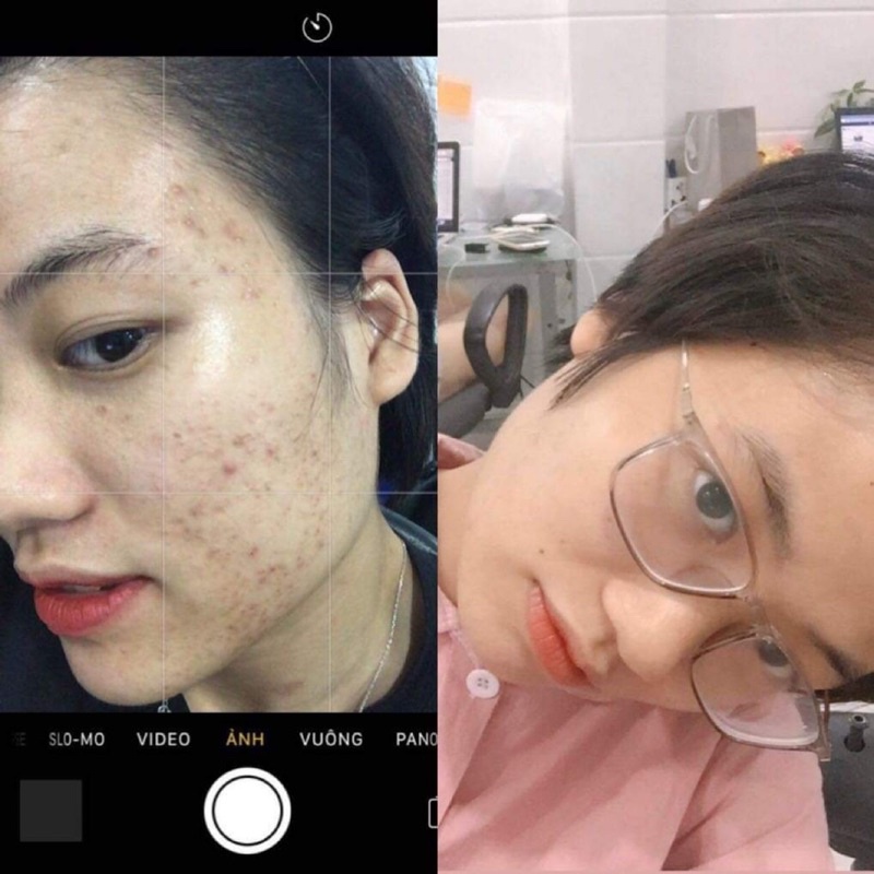 Serum mụn Nhà Bơ