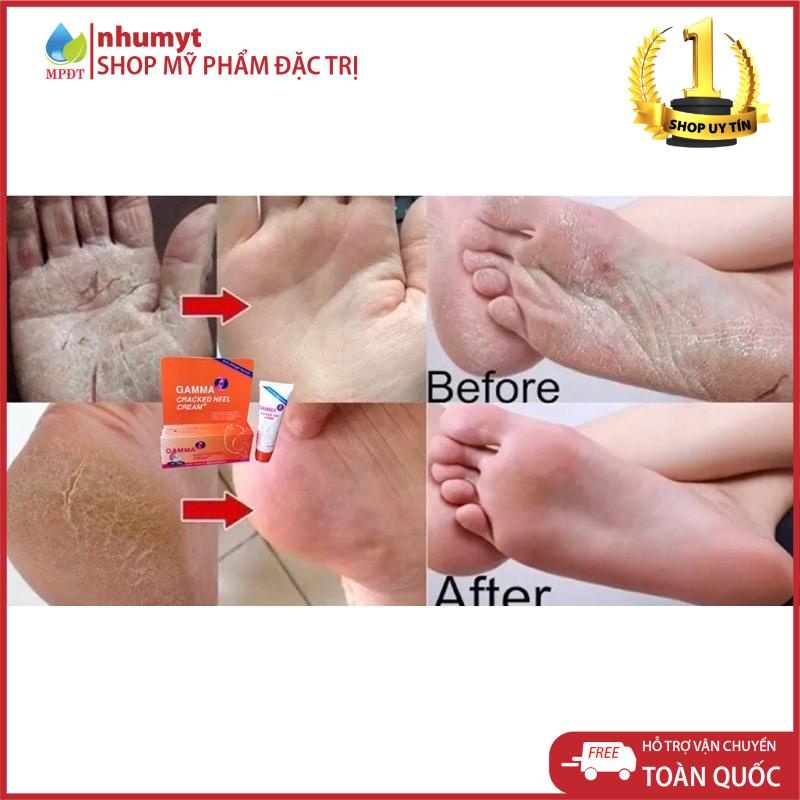 Kem giảm nứt gót chân, tay, giảm khô nẻ Gamma Cracked Heel