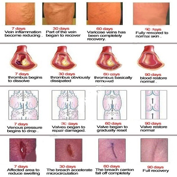 (Hàng Mới Về) Thuốc Mỡ Trị Giãn Tĩnh Mạch An Toàn Và Hiệu Quả