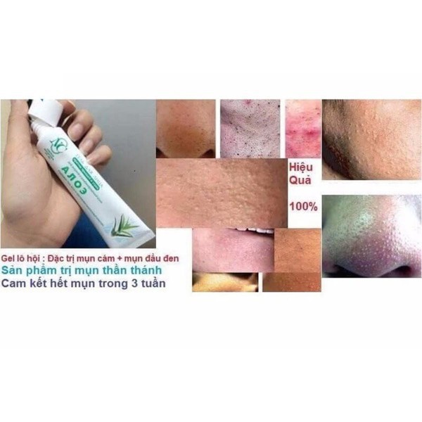 Gel lô hội giảm hết mụn bọc, mụn cám, mụn ẩn trong 1 [hàng chính hãng Nga ] | BigBuy360 - bigbuy360.vn