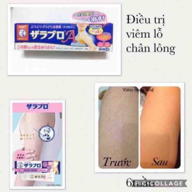 KEM TRỊ VIÊM LỖ CHÂN LÔNG ZARAPORO ROHTO NHẬT BẢN