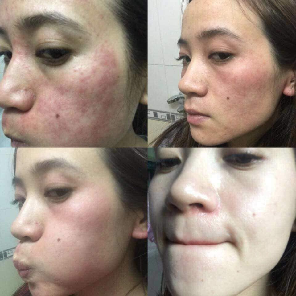 Tinh chất mụn ACNE SKIN SERUM Chamomileskill 100ml | BigBuy360 - bigbuy360.vn