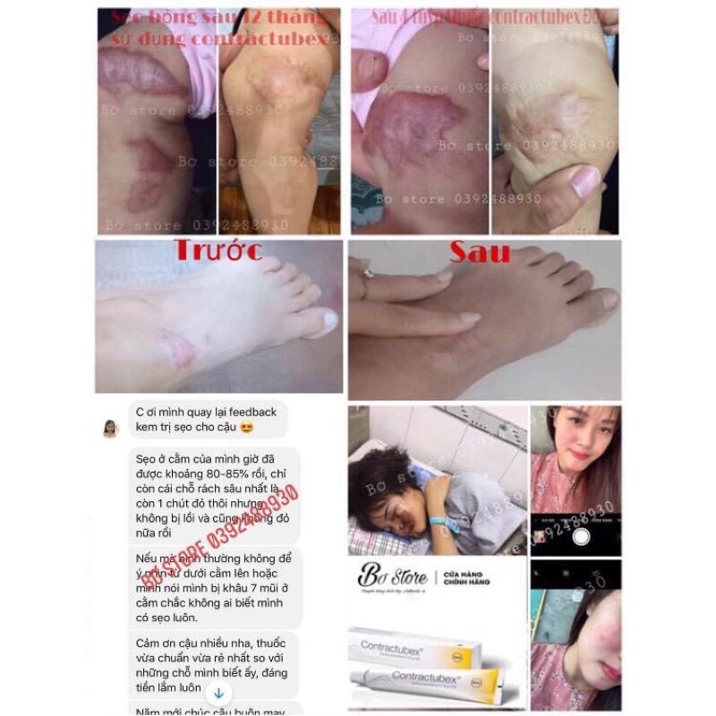 [NỘI ĐỊA ĐỨC] Kem làm mờ sẹo Contractubex Đức, tuýp 30g (Có bill) | BigBuy360 - bigbuy360.vn