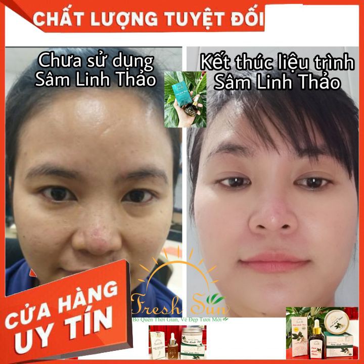 Sâm Linh Thảo [CHÍNH HÃNG] 💞 Đánh bay các loại MỤN, nám, tàn nhang