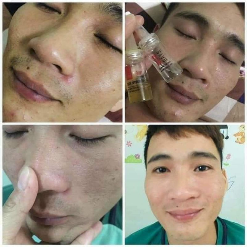 Ngăn Ngừa Mụn LinhHương | BigBuy360 - bigbuy360.vn