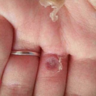 Serum tẩy mụn cóc,  mụn ruồi Thái Lan