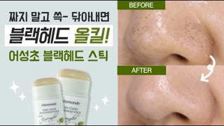 THANH LĂN MỤN MAMONDE