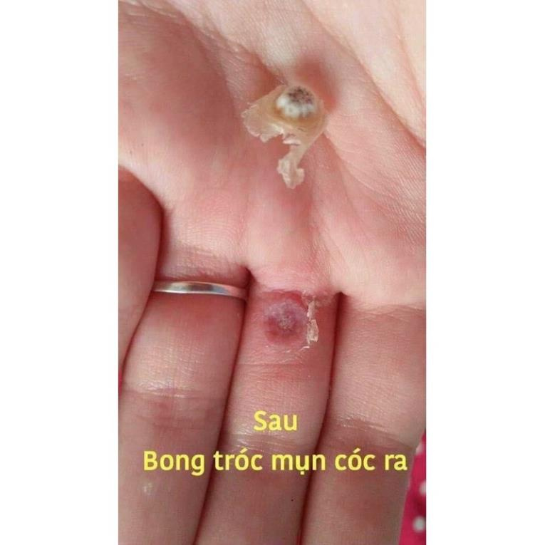Gel tẩy nốt ruồi Nga