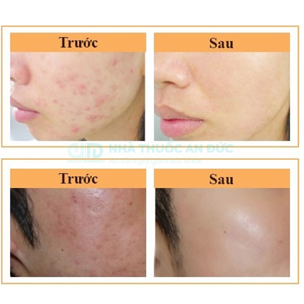 Derma Forte Kem Giảm Mụn Ngừa Thâm Trứng Cá, Mụn Ẩn, Mụn Đầu Đen, Kem Derma Forte 15g