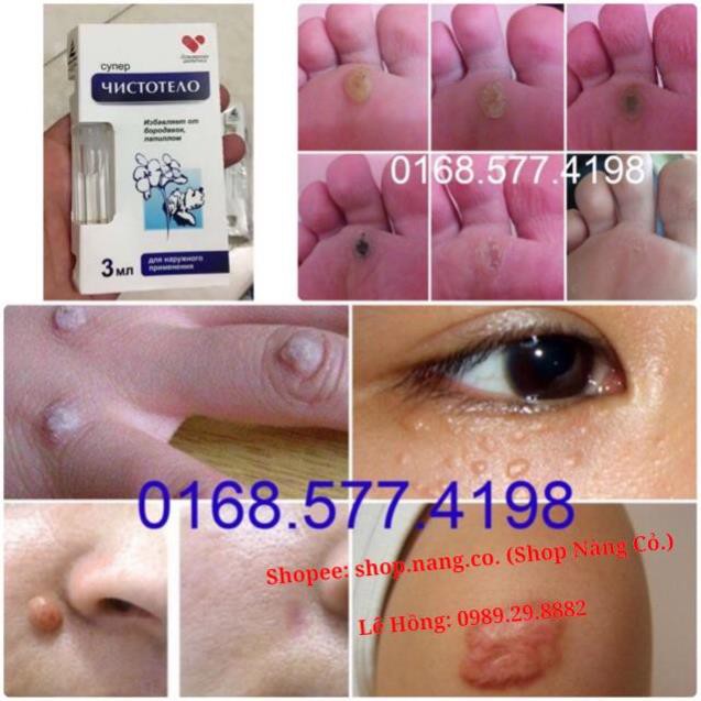 [Chính Hãng] Loại 3ml GEL TẨY NỐT RUỒI, MỤN CƠM, MỤN CÓC, SẸO LỒI, THỊT THỪA - Dvelinil nhập khẩu Nga Hiệu quả Tốt