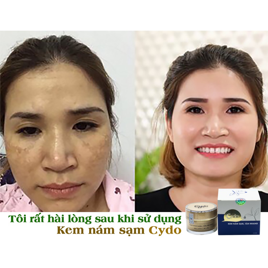 Kem trị mọi loại nám sạm, tàn nhang CyDo chính hãng