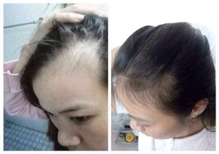 TINH DẦU BƯỞI TRỊ RỤNG TÓC VIJULLY