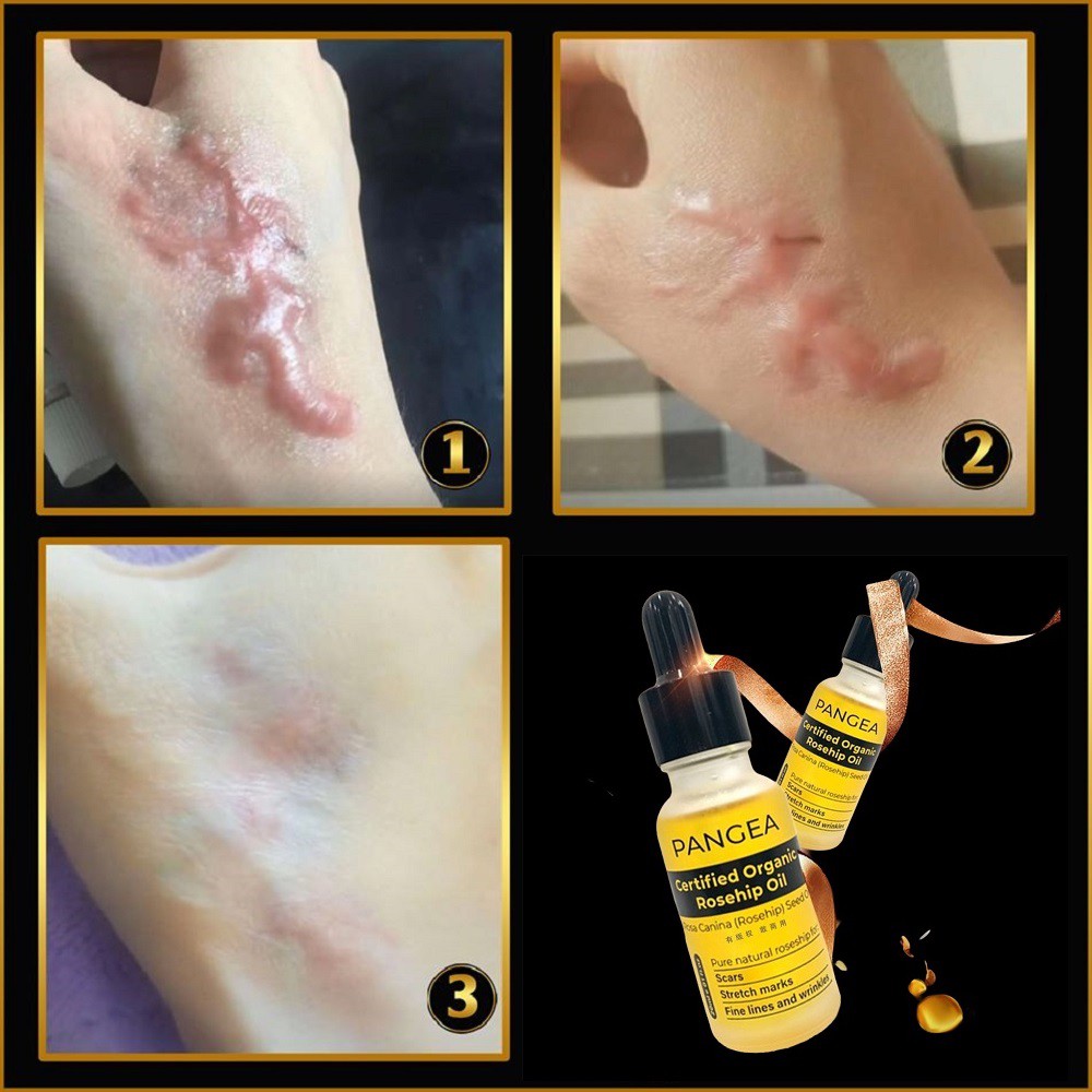 Serum Xóa Sẹo Lồi - Sẹo Lõm - Sẹo Rỗ Lâu Năm PANGEA 20ml