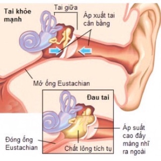 Xịt ráy tai Clearears Úc 30ml