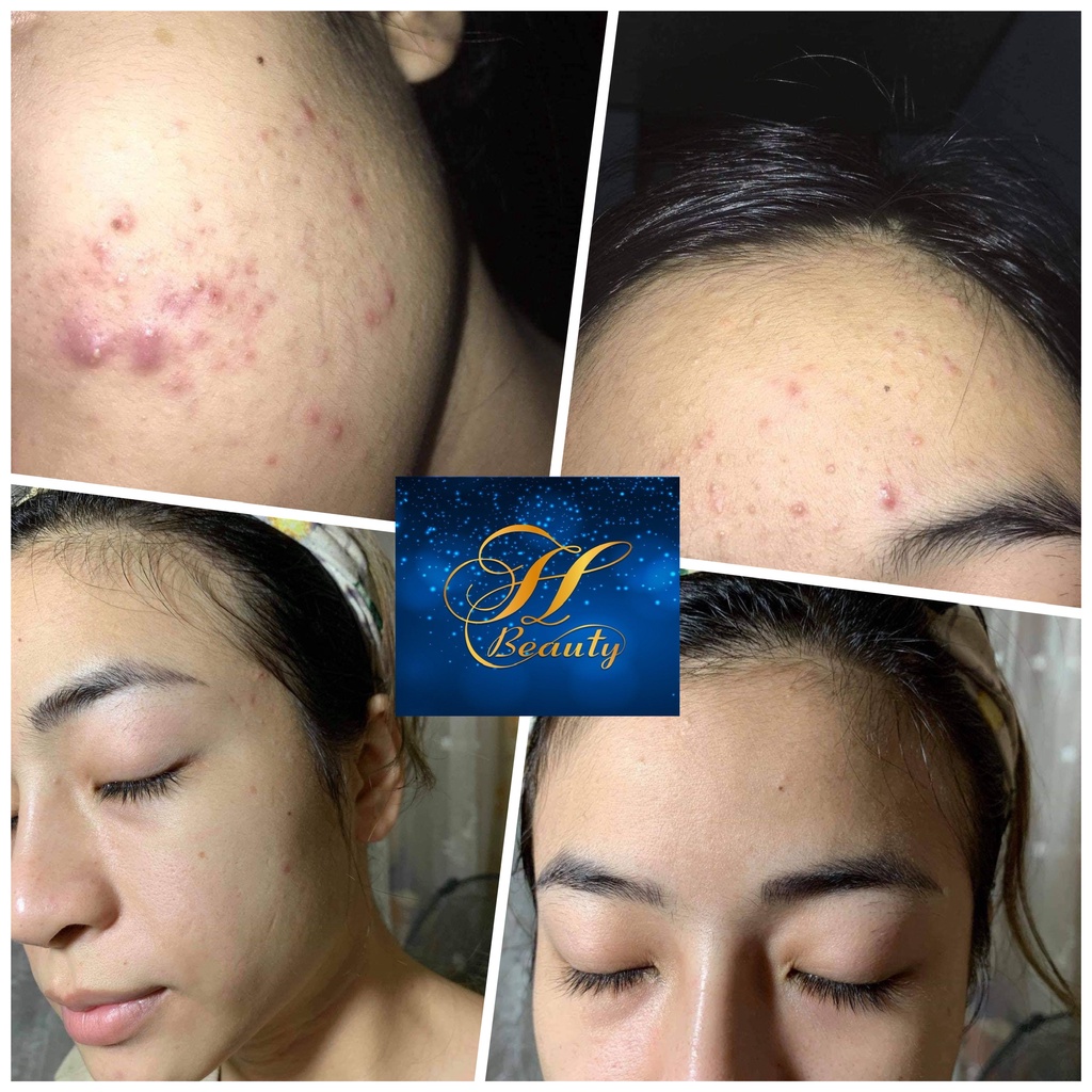 [Hiệu Quả Khác Biệt Sau 2 Tuần Sử Dụng] Kem Mụn X1 TH beauty giảm mụn mờ vết thâm | BigBuy360 - bigbuy360.vn