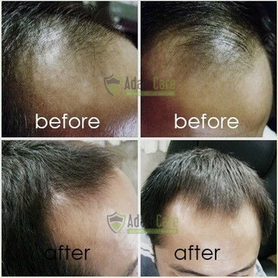 Thuốc Mọc Râu Minoxidil 5% Combo 3 Foam