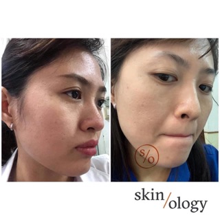 Miracle peel ( tẩy tế bào chết sinh học)